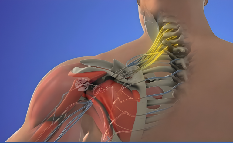 Doctor providing brachial plexus injury treatment and therapy to patient in Delhi clinic